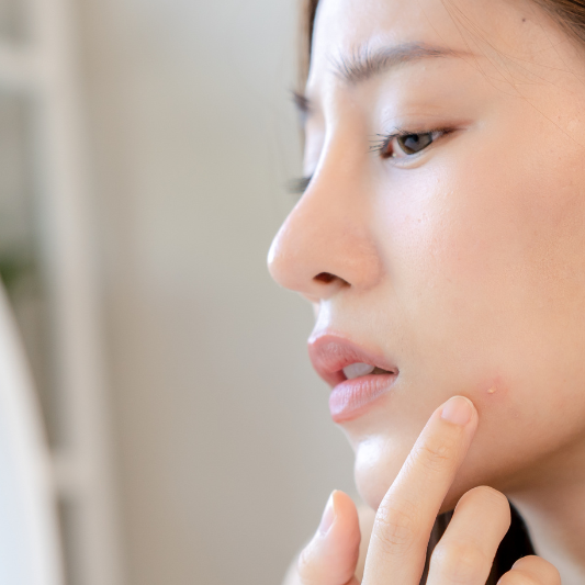 Beautiful Asian Woman - Acne Supplements and Vitamins for Acne Prone Skin